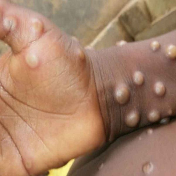 argentina-reports-case-of-monkeypox--man-travelled-from-spain-2022-05-27